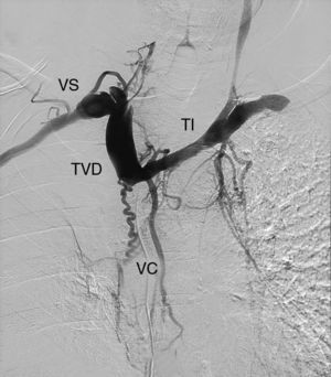 Angiografía. TI: tronco innominado; TVD: tronco venoso derecho; VC: vasos colaterales; VS: vena subclavia.