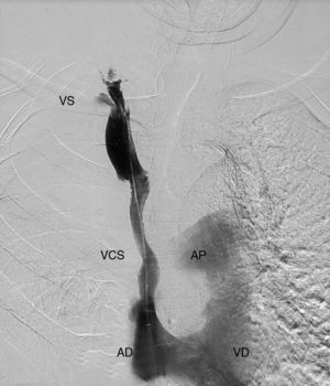 Angiografía tras el tratamiento realizado. AD: aurícula derecha; AP: arteria pulmonar; VCS: vena cava superior; VD: ventrículo derecho; VS: vena subclavia.