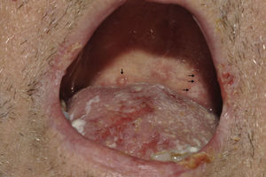 Aspecto de la cavidad oral con lesiones típicas en el paladar.