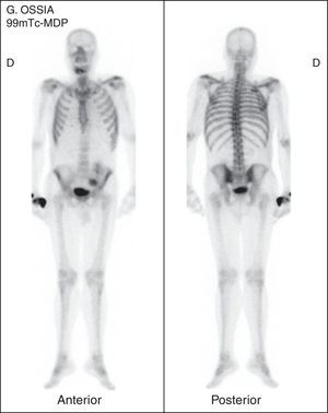 Gammagrafía ósea. Depósito patológico a nivel mandibular.