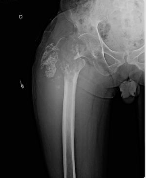 Radiografía de cadera derecha.