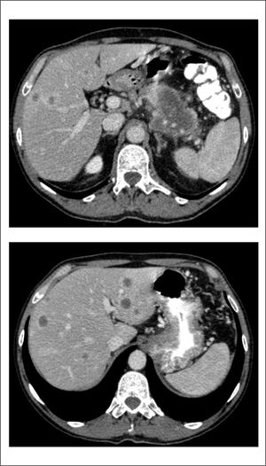 Imágenes de tomografía computarizada basal al diagnóstico. Se objetivan metástasis hepáticas múltiples y una masa tumoral en la cabeza pancreática.