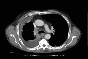 Tomografía computarizada de tórax: derrame pleural derecho con atrapamiento del pulmón derecho.