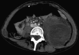 TAC abdominal donde se visualiza el tumor y la compresión que provoca.