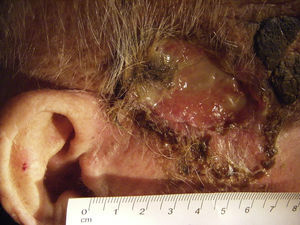 Imagen a los 33 días después del tratamiento radioterápico.
