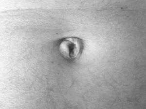 Nódulo de la hermana María José.