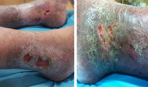 Evolución de las diferentes úlceras antes (imagen izquierda) y después (imagen derecha) del tratamiento con sevoflurano tópico.