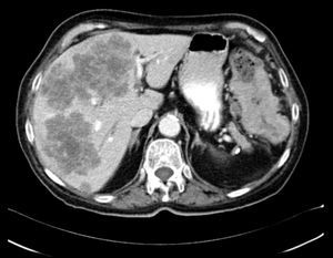 TAC abdominal: lesiones hepáticas múltiples, compatibles con metástasis; también se aprecia el engrosamiento de la pared del colon izquierdo.