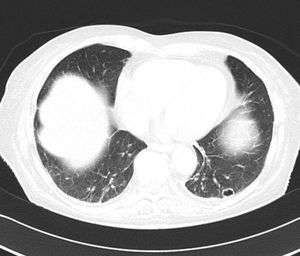 TAC torácico: nódulo pulmonar izquierdo cavitado.