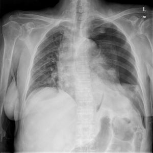 Radiografía de tórax en qe se aprecia un neumotórax izquierdo junto con nódulos pulmonares bilaterales.