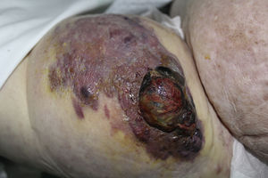 Tumoración de gran tamaño en cara lateral externa de muslo izquierdo.