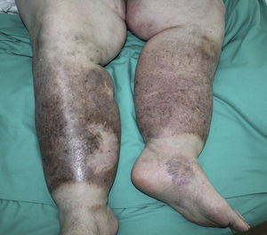 Linfedema bilateral acompañante en ambos miembros inferiores.
