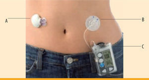 continuous glucose monitor/monitoring