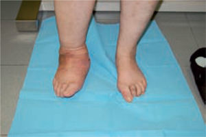 Ankle instability in Charcot foot