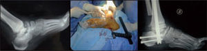 Ankle fusion using intramedullary nails