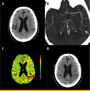 Imagen funcional en el ictus isquémico agudo. Tomografía computarizada (TC) craneal con estudio de perfusión en un paciente de 57 años con diabetes, con un ictus isquémico agudo en el hemisferio izquierdo tratado con fibrinolisis intravenosa, que presentaba una glucemia al ingreso de 256mg/dL. La TC craneal basal no aprecia alteraciones relevantes (A), en la angio-TC se observa oclusión arterial de una subdivisión de la arteria cerebral media izquierda (flecha verde en la imagen B), y el estudio de perfusión muestra un área de isquemia irreversible y penumbra circundante en la región parietooccipital izquierda (en rojo en la imagen C). En la TC craneal de control realizada a las 24 horas se observa un infarto agudo en la región alterada previamente en la TC de perfusión (flecha y contorno negro en D)