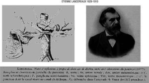 Etiènne Lancereaux (1829-1910) introduced the concept of pancreatic diabetes (1877).