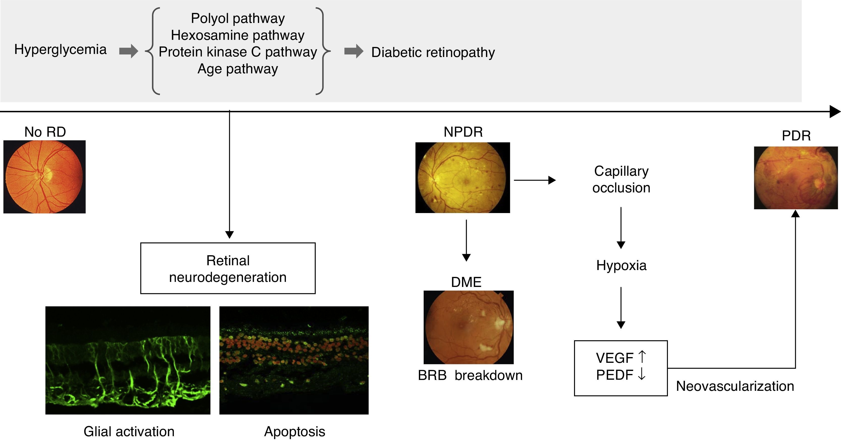 Neurodegeneration in diabetic retinopathy: Current concepts and ...