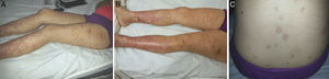 Lupus eritematoso cutáneo agudo (ACLE). Forma generalizada.