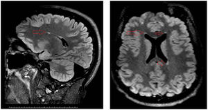 Caso clínico 1: resonancia magnética cerebral sin contraste intravenoso, secuencia FLAIR. Se observan imágenes micronodulares isointensas con la corteza cerebral adyacentes los ventrículos laterales compatibles con focos de sustancia gris heterotópica subependimaria (flechas).