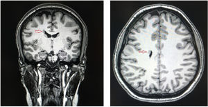 Caso clínico 2: resonancia magnética cerebral sin contraste intravenoso, secuencia 3D T1. Se observa nódulo un nódulo único en la pared del ventrículo lateral derecho de señal similar a sustancia gris, compatible con foco de sustancia gris heterotópica subependimaria (flecha).