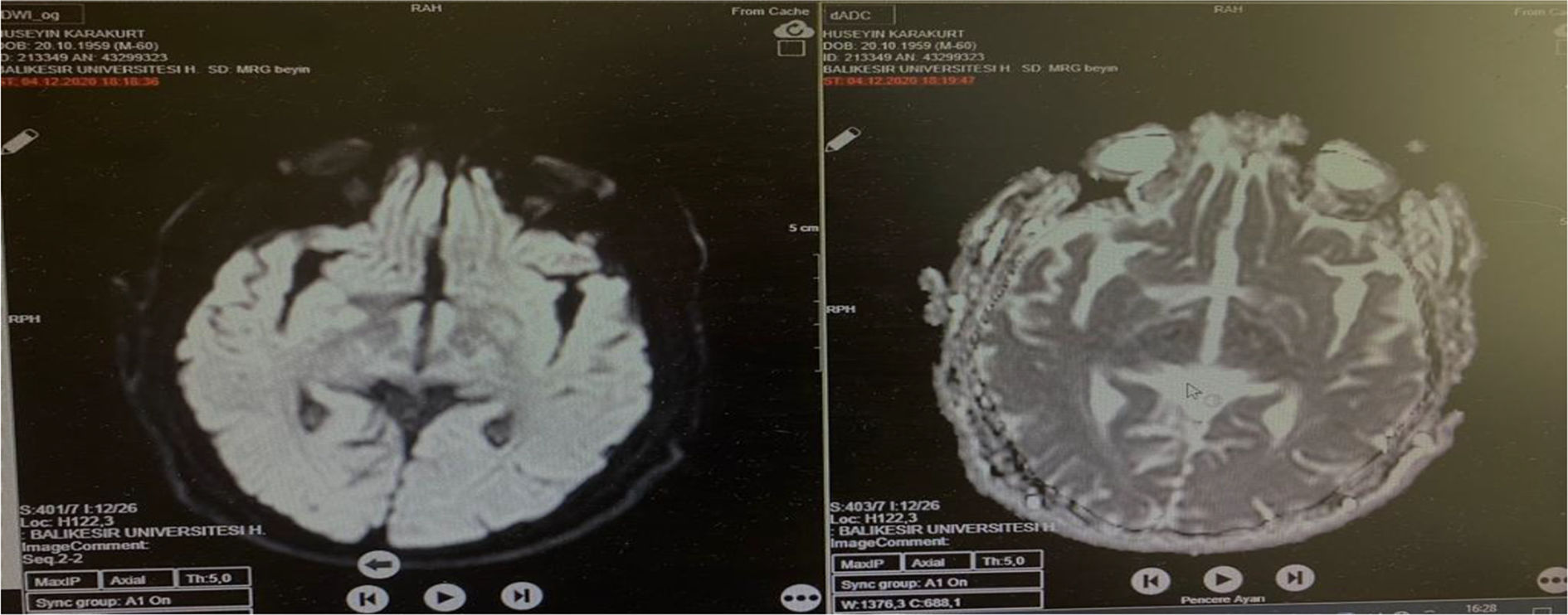 Development of frontotemporal dementia in a patient followed up with ...