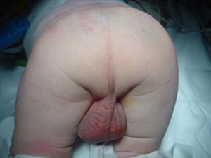 Imagen de malformación anorrectal del paciente.