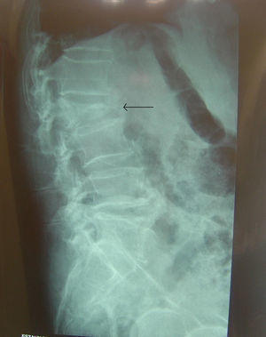 En la radiografía se observa aplastamiento vertebral en L2.