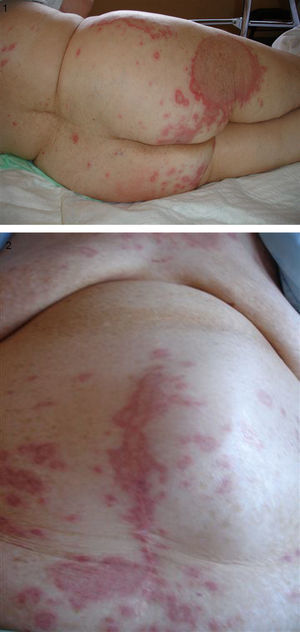 Detalle de las lesiones maculopapulosas distribuidas en el tronco, el abdomen y las extremidades.