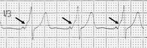 Anomalía electrocardiográfica de WPW. Se observa un PR corto y un ensanchamiento del QRS por la presencia de un empastamiento inicial, la onda delta (flecha). Ver explicación en texto.