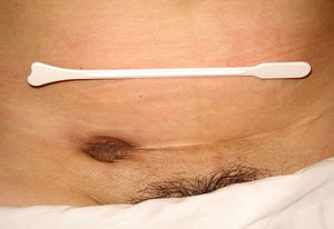 Lesión endometriósica a nivel de cicatriz de cesárea.