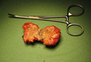 Nódulo endometriósico abierto tras la exéresis.