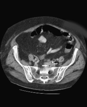 Fase retardada de TC con contraste oral e i.v. Absceso presacro con burbuja aérea en su interior (flecha blanca). Se aprecia señalado con flecha negra el uréter ectásico relleno de contraste, justo hasta la zona del absceso.