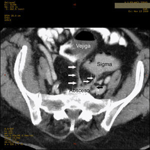 Estudio realizado con TC, con contraste oral, i.v. y endorrectal, reformación multiplanar en eje axial para demostrar trayecto fistuloso (flechas blancas) desde el colon sigmoides hacia el absceso residual presacro,y desde este hacia la vejiga, donde presenta nivel hidroaéreo en relación con neumaturia. Con flecha negra se señala uréter izquierdo.