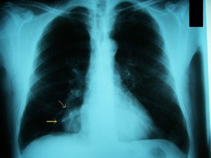 Radiografía posteroanterior de tórax. Quiste pericárdico (flechas).