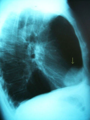 Radiografía lateral de tórax. Quiste pericárdico (flecha).