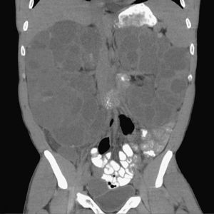 TC abdominal con contraste mostrando los riñones aumentados de tamaño con múltiples quistes, algunos de los cuales se encuentran abscesificados.