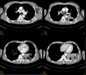 Serie de imágenes de consolidación parenquimatosa que afecta a LII del pulmón.