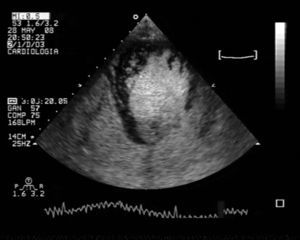 Ecocardiograma: proyección apical 4-cámaras con contraste ecocardiográfico que muestra la presencia de contraste entre los recesos trabeculares a nivel apical y lateral distal a la inserción del músculo papilar.