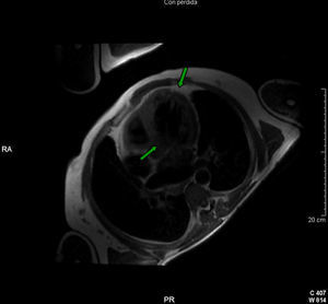 Imagen de RMN cardiaca (corte torácico sobre ventrículo izquierdo) en el que se aprecia el excesivo número de trabeculaciones miocárdicas con recesos intertrabeculares profundos (flechas).