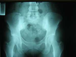 Radiografía de las articulaciones sacroilíacas con erosiones y esclerosis bilateral.