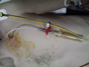 Imagen del paciente con el tubo de toracostomía ya colocado.