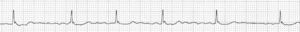 Fibrilación auricular. Las ondas P son sustituidas en esta arritmia por oscilaciones rápidas de la línea de base u ondas fibrilatorias. La frecuencia ventricular, irregular, es en este caso de unos 60–70lpm.