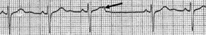 Extrasístole auricular bloqueado.