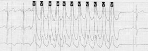 Taquicardia ventricular no sostenida.