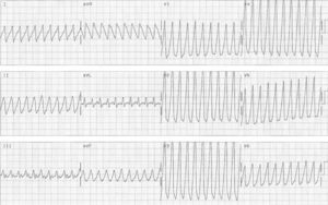Taquicardia ventricular; ausencia de complejos RS en precordiales.