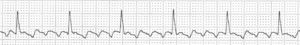 Flutter auricular 4:1. Derivación II. La actividad auricular está constituida por ondas regulares con morfología «en dientes de sierra» a unos 300lpm. La frecuencia ventricular es de 75lpm pues la conducción AV es 4:1.