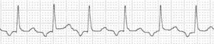 Taquicardia auricular uni- o monofocal. Derivación II. Se expone con intención didáctica una taquicardia no muy rápida (111lpm) en la que se observa que cada QRS está precedido de ondas P′ de morfología idéntica entre sí, pero distintas a la sinusal. Habitualmente son más rápidas, de modo que cuando la conducción es 1:1 las ondas P′ suelen quedar enmascaradas en la onda T precedente.