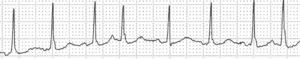 Taquicardia auricular multifocal. Derivación II. Nótese que la arritmia es irregular y que las ondas P que preceden a los QRS son de diferente morfología (al menos 3 morfología diferentes).