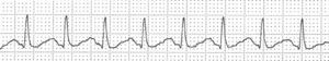 Taquicardia regular de QRS estrecho.